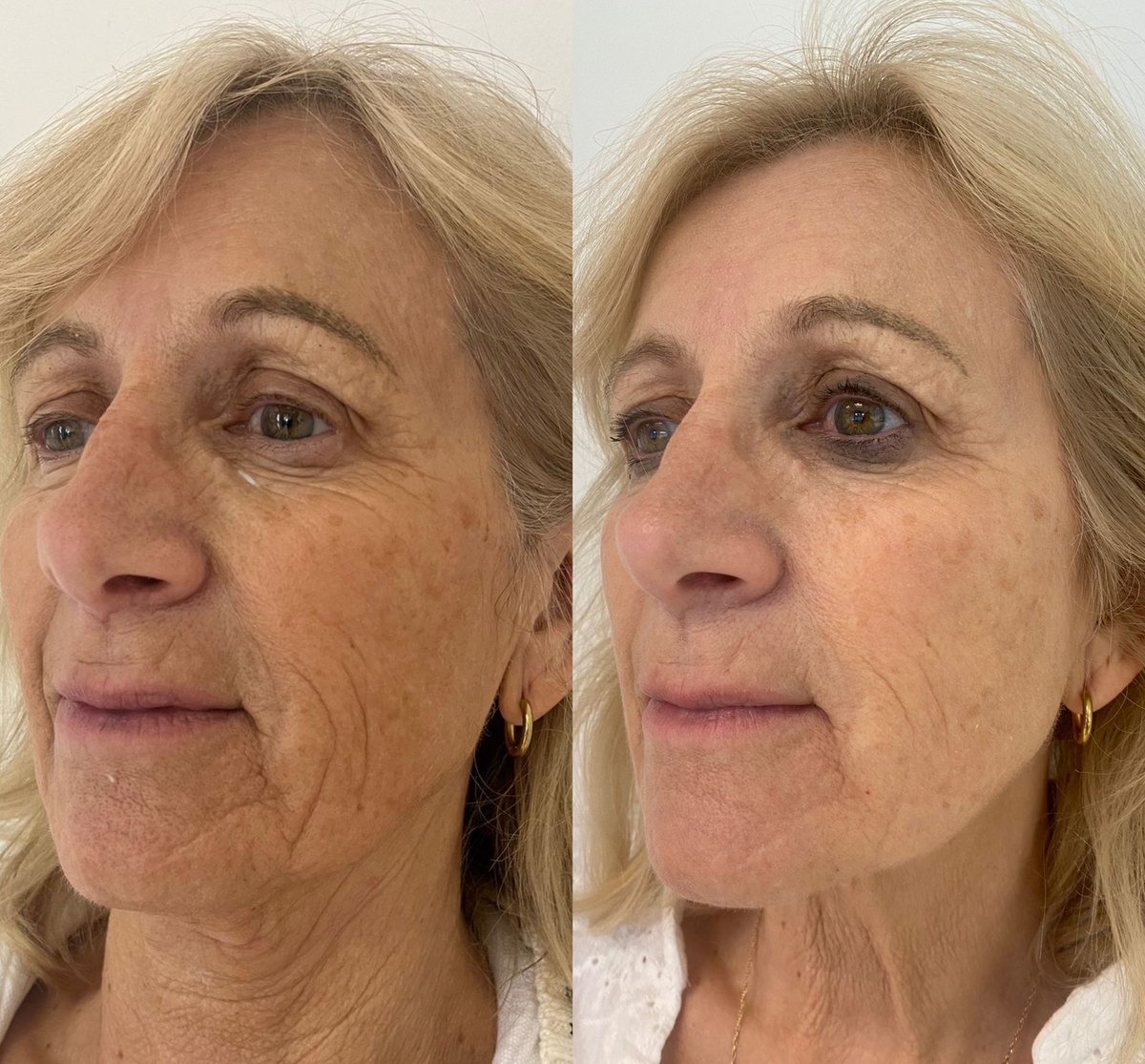 Before and after RF microneedling — a Lumos Skin client showing smoother skin texture and softer fine lines four weeks after one treatment